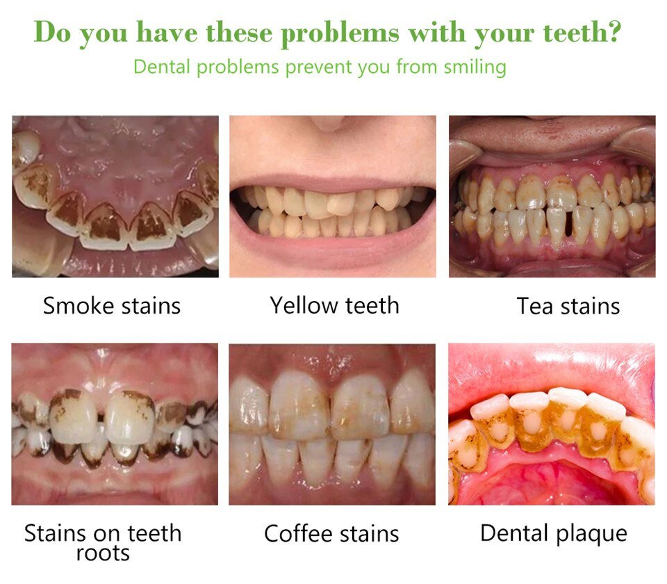 SUAI Teeth Whitening Essence Kit Dental Teeth Whitener Bleach Powder Oral Hygiene Dental Tools Remove Plaque Stains Fresh Breath SUAI Teeth Whitening Essence Kit Dental Teeth Whitener Bleach Powder Oral Hygiene Dental Tools Remove Plaque Stains Fresh Breath