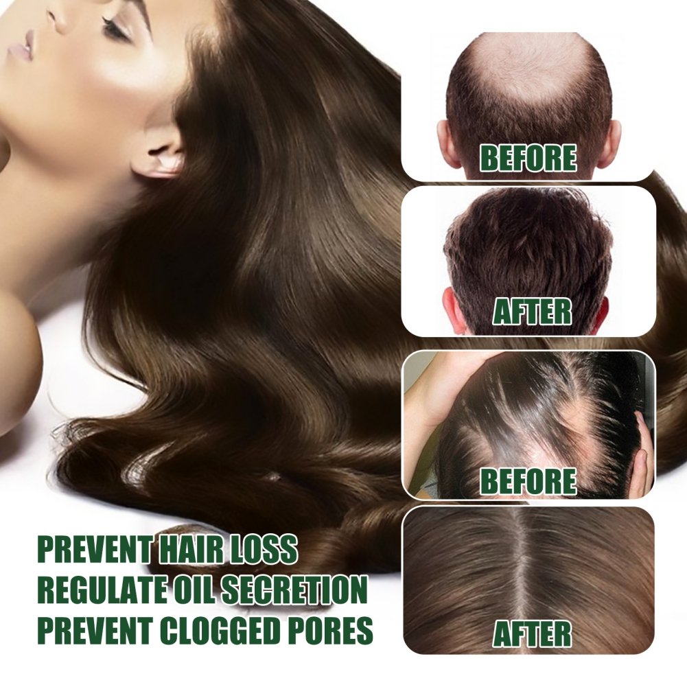 10/15/20/40ml Fast Hair Regrowth Essential Oil 7 Days Anti-loss Strong the Root of Hair Serum Ginger Hair Loss Treatment 10/15/20/40ml Fast Hair Regrowth Essential Oil 7 Days Anti-loss Strong the Root of Hair Serum Ginger Hair Loss Treatment