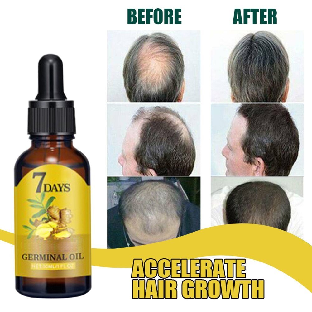 10/15/20/40ml Fast Hair Regrowth Essential Oil 7 Days Anti-loss Strong the Root of Hair Serum Ginger Hair Loss Treatment 10/15/20/40ml Fast Hair Regrowth Essential Oil 7 Days Anti-loss Strong the Root of Hair Serum Ginger Hair Loss Treatment