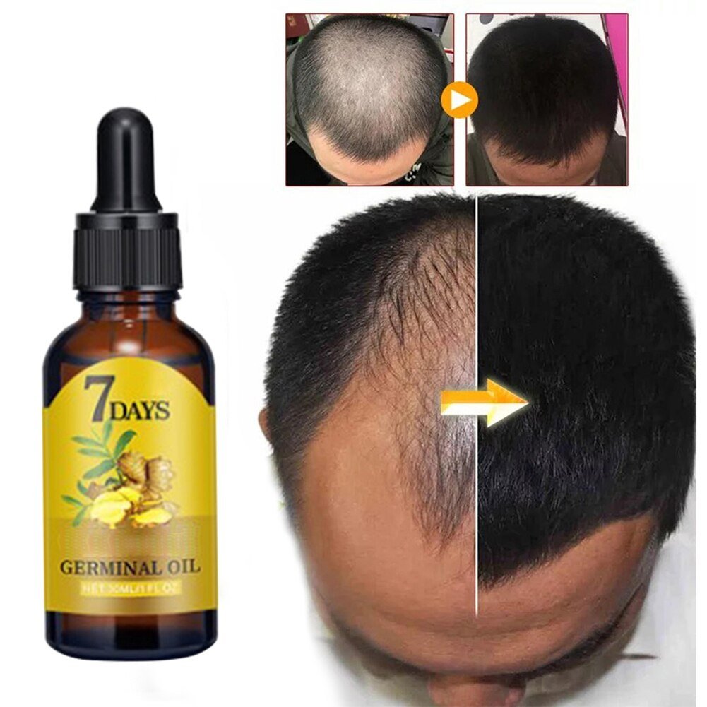 10/15/20/40ml Fast Hair Regrowth Essential Oil 7 Days Anti-loss Strong the Root of Hair Serum Ginger Hair Loss Treatment 10/15/20/40ml Fast Hair Regrowth Essential Oil 7 Days Anti-loss Strong the Root of Hair Serum Ginger Hair Loss Treatment