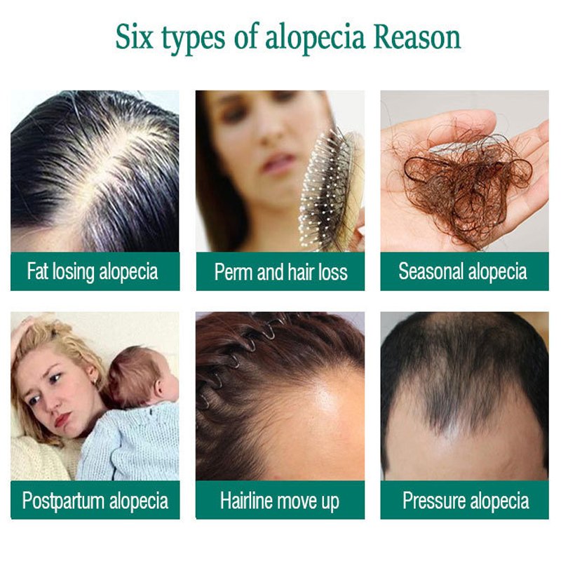 Ginger Hair Growth Essence Oils Products Anti Hair Loss Treatement Fast Growing Germinal Serum Prevent Scalp Damaged Men Women Ginger Hair Growth Essence Oils Products Anti Hair Loss Treatement Fast Growing Germinal Serum Prevent Scalp Damaged Men Women