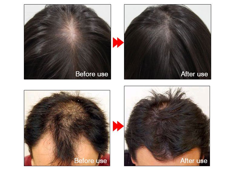 Ginger Hair Growth Essence Oils Products Anti Hair Loss Treatement Fast Growing Germinal Serum Prevent Scalp Damaged Men Women