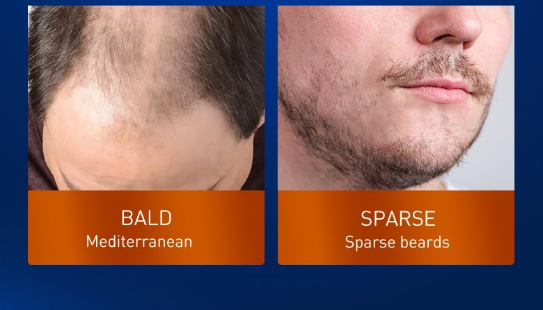 PURC Hair Growth Products Biotin Fast Grow Hair Oil Beard Growth Oil Anti Hair Loss Sprays For Men Women Beauty Health Care 30ML PURC Hair Growth Products Biotin Fast Grow Hair Oil Beard Growth Oil Anti Hair Loss Sprays For Men Women Beauty Health Care 30ML