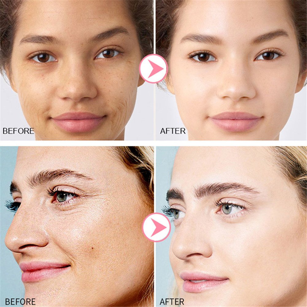 Effective Whitening Cream Freckle Cream Remove Dark Spots Fade Acne Scars Melanin Pigmentation Melasma Anti-Aging Brighten Skin Effective Whitening Cream Freckle Cream Remove Dark Spots Fade Acne Scars Melanin Pigmentation Melasma Anti-Aging Brighten Skin